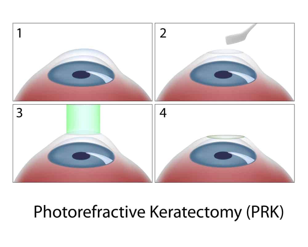 Is PRK Better Than LASIK?